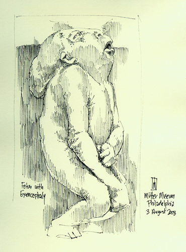 "Fetus with exencephaly (Mtter Museum)" is copyright  2008 by James G. Mundie. All rights reserved.  Reproduction prohibited.