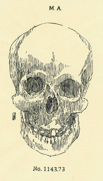 "Skull of Mary Ashberry (Mtter Museum)" is copyright  2009 by James G. Mundie. All rights reserved.  Reproduction prohibited.
