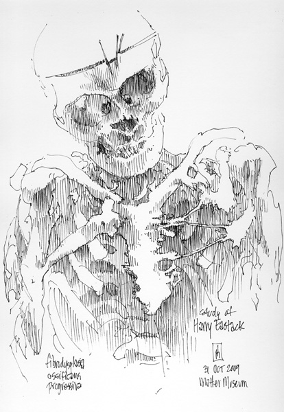 "Skeleton of Harry Eastlack (Mtter Museum)" is copyright  2009 by James G. Mundie. All rights reserved.  Reproduction prohibited.