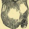 P1535 (Two-headed Boy of Bengal)